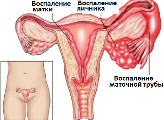 Стрептококк у женщин гинекология