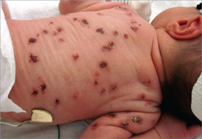 цитомегаловирус у новорожденных